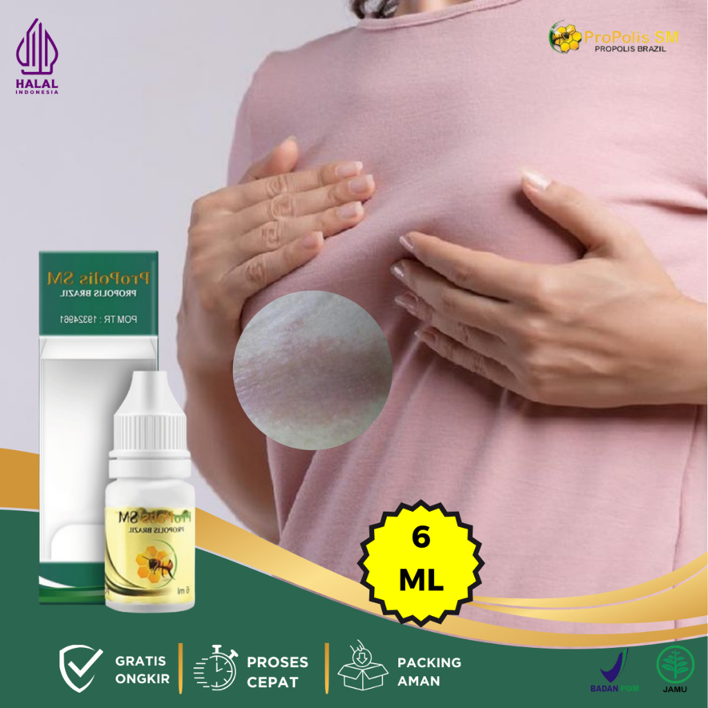 Obat Oles Gatal Lipatan Payudara, Obat Gatal Payudara, Obat Ruam Merah Di Bawah Lipatan, Obat Payuda