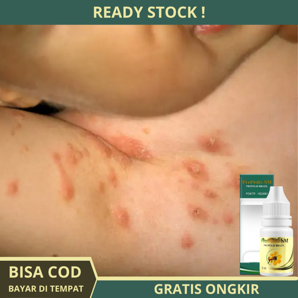 Obat Scabies Manusia, Obat Gatal Scabies Manusia, Obat Obat Scabies Untuk Manusia, Obat Gatal Scabie