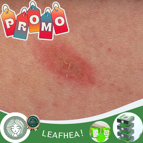 Obat Pityriasis Rosea, Pityriasis Alba, Obat Penghilang Bekas Gatal Yang Menghitam Seperti Kadas, Ku