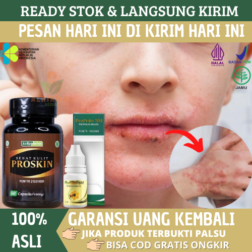 Obat Gatal Eksim Di Wajah, Eksim Di Tangan, Eksim Di Kaki, Eksim Di Kepala, Eksim Di Daun Telinga, O