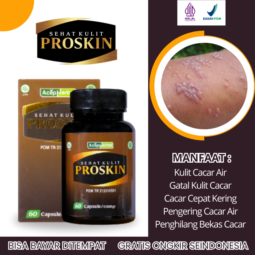 Obat Cacar Air, Obat Cacar Api, Obat Cacar Cepat Kering, Obat Pengering Cacar, Obat Penghilang Bekas