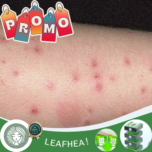 Obat Gigitan Nyamuk, Obat Gigitan Nyamuk Untuk Bayi, Penghilang Bekas Gigitan Nyamuk Anak & Dewasa -