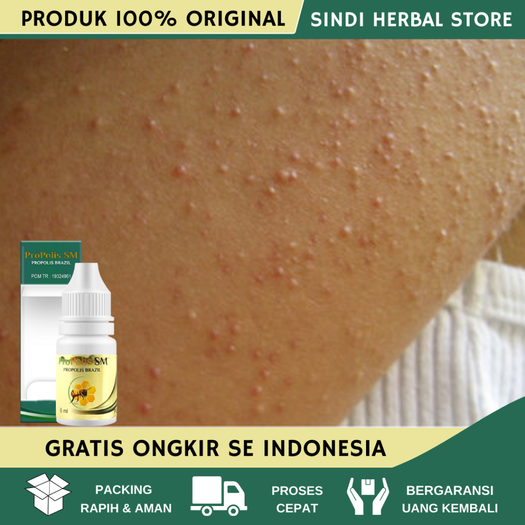 Obat Gatal Pantat, Obat Gatal Di Pantat, Obat Pantat Burik Gatal, Obat Gatal dan Hitam di Pantat, Ob