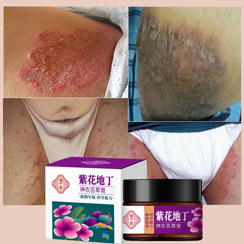 COD【100% Asli】Salep gatal paling ampuh Obat gatal kulit Obat gatal selangkangan Obat gatal paling am