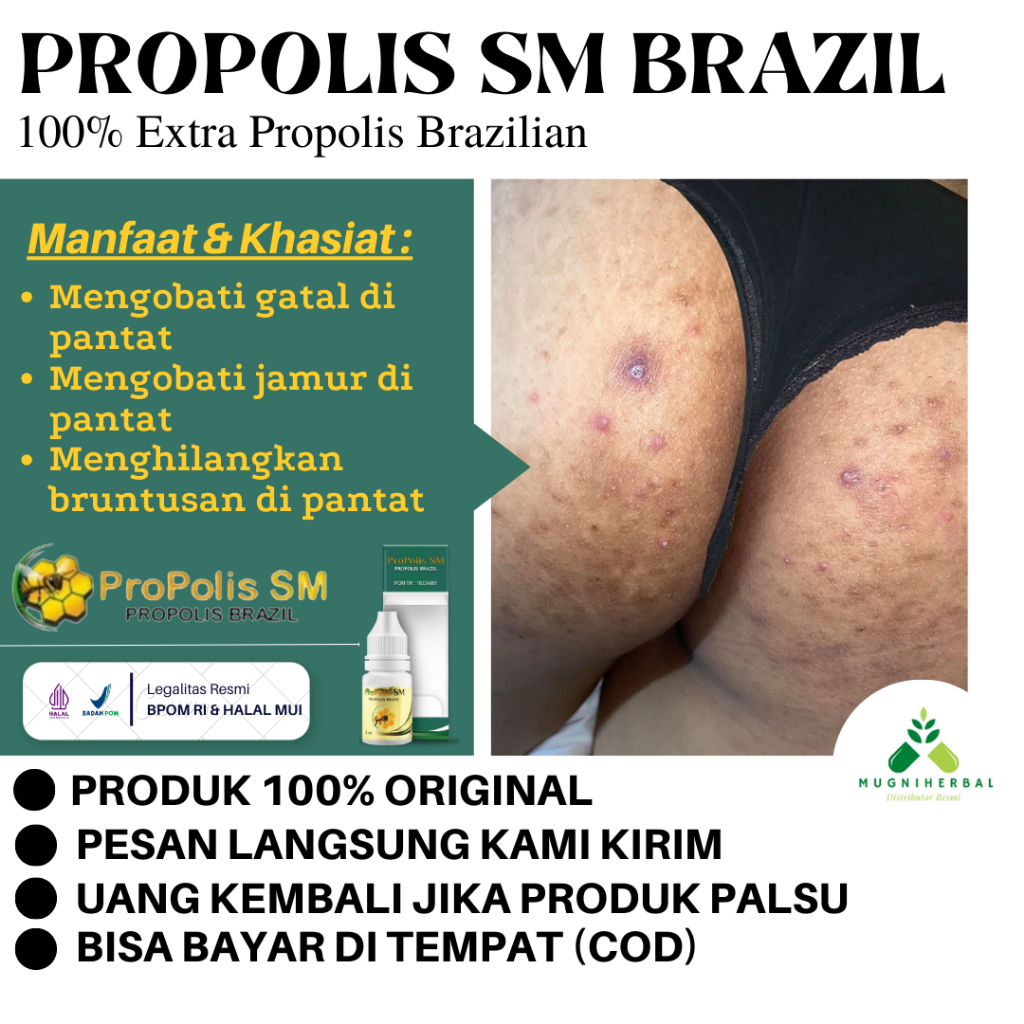 Propolis SM - Obat Bokong Gatal, Pantat Gatal, Luka Lecet Di Bokong, Gatal Ruam Di Bokong, Bekas Luk