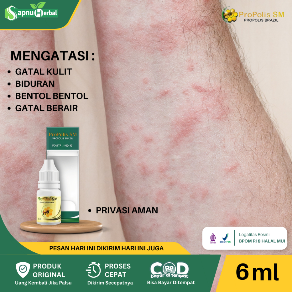 Obat Gatal Berair di Jari Tangan dan Kaki, Bintik Berair, Kutu Air, Penghilang Bintik Berair Di Tela