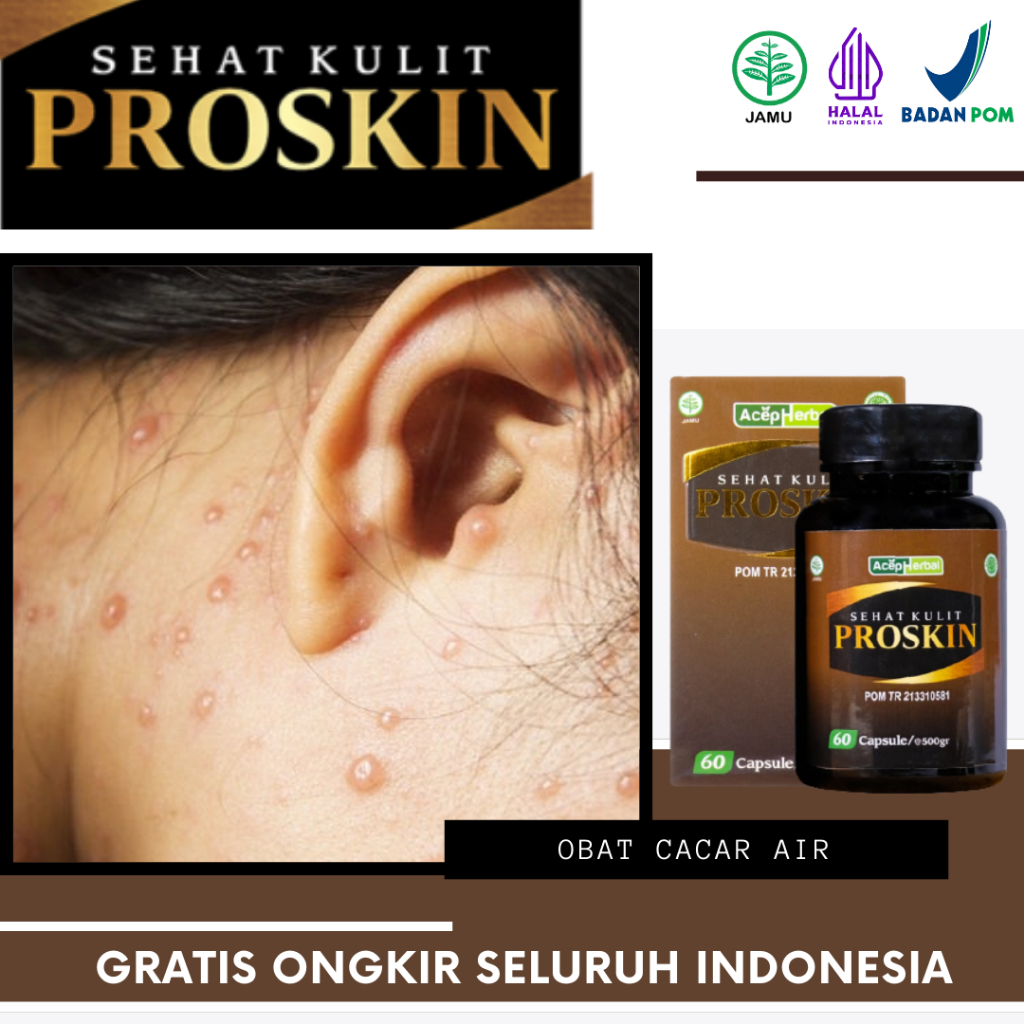 Proskin - Obat Cacar Air, Cacar Api, Herpes Kulit, Cacar Bernanah, Cacar Bisul, Cacar Monyet, Gatal 