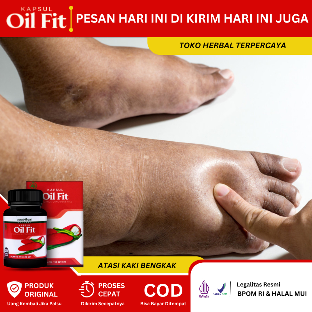 Obat Kaki Bengkak, Obat Pengempeskan Kaki Bengkak, Obat Jantung Bengkak, Obat Kaki Bengkak Diabetes 