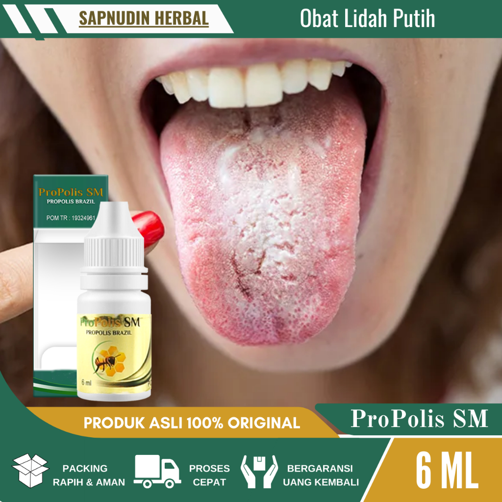 Obat Lidah Putih, Obat Lidah Berjamur, Obat Infeksi Jamur di Lidah Dengan ProPolis SM Isi 6 ML