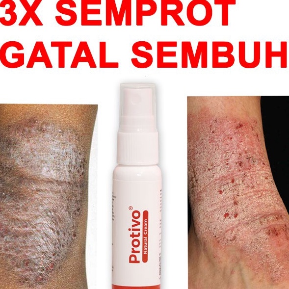 DISKON Protivo Natural Cream  Obat Gatal  Salep Gatal  Cream Gatal  Obat Kulit Gatal  Obat Gatal Men