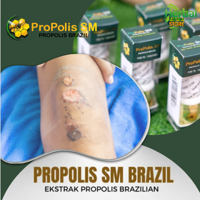 Herbal Penghilang bekas koreng di kaki, obat salep koreng di kaki Propolis, koreng di kaki gatal, ca