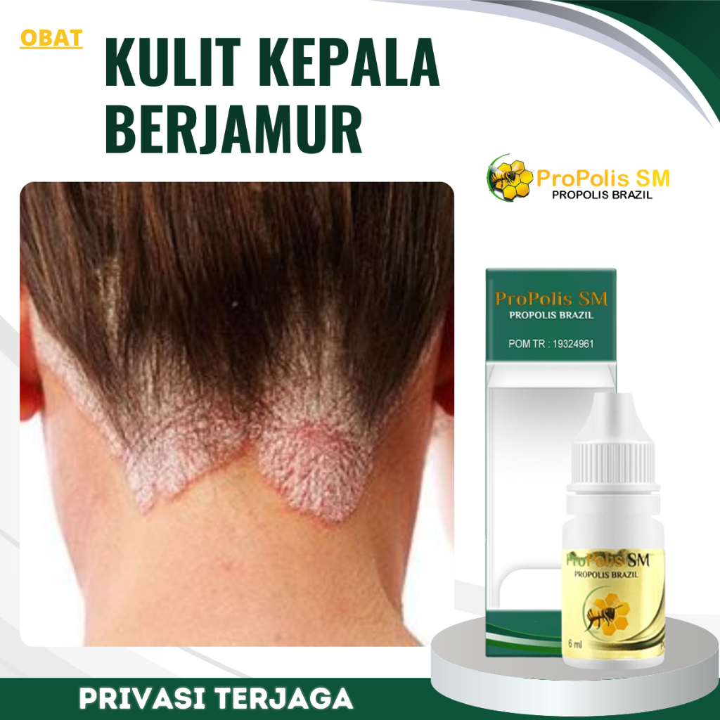 Obat Kulit Kepala Berjamur, Obat Gatal kulit Kepala, Obat Penghilang Jamur Kulit Kepala, Obat Ketomb