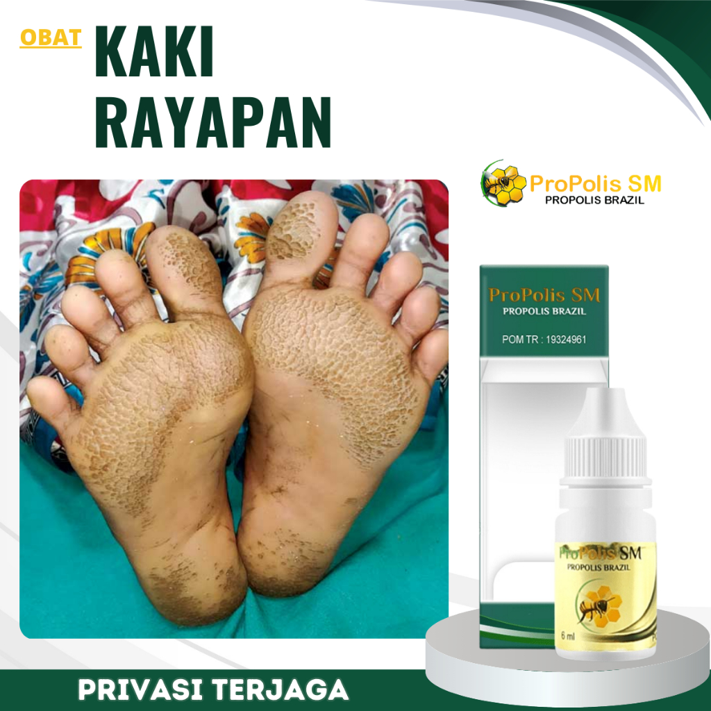 Obat Kaki Rayapan, Obat Telapak Kaki Berlubang, Obat Kaki Pecah Pecah, Obat Kaki Jamuran, Obat Kutu 