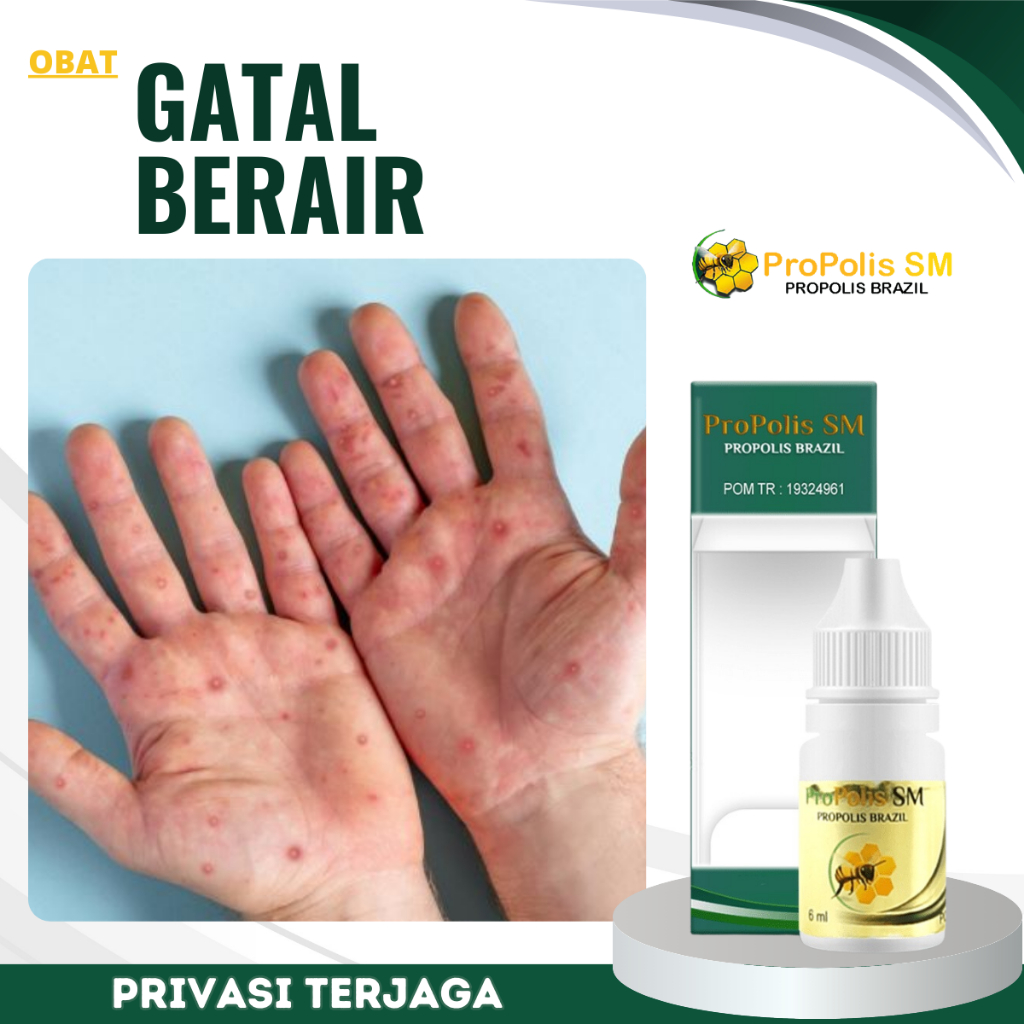 Obat Gatal Berair, Obat Penghilang Gatal Berair, Obat Cacar, Obat Scabies, Onat Herpes, Obat Penghil