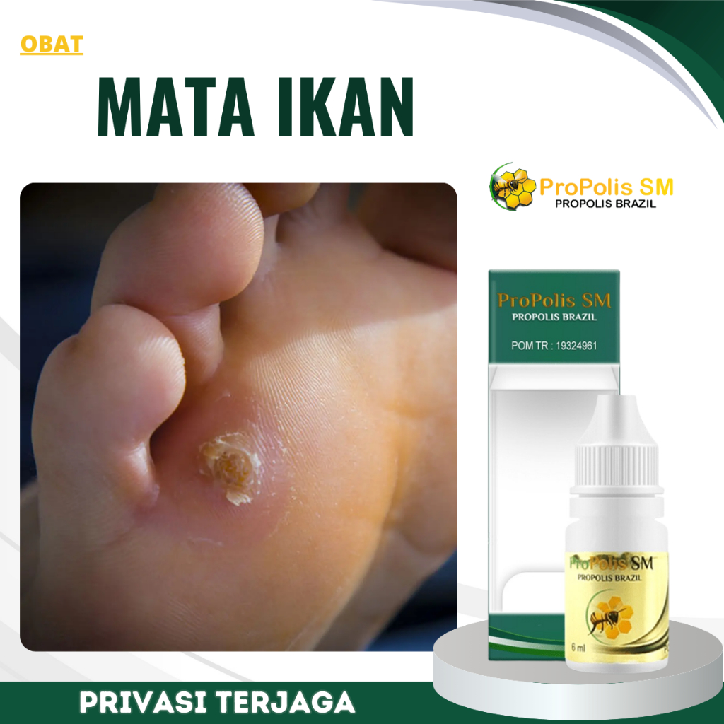 Obat Mata Ikan, Obat Perontok Mata Ikan, Obat Penghilang Mata Ikan, Obat Oles Penghilang Mata Ikan, 