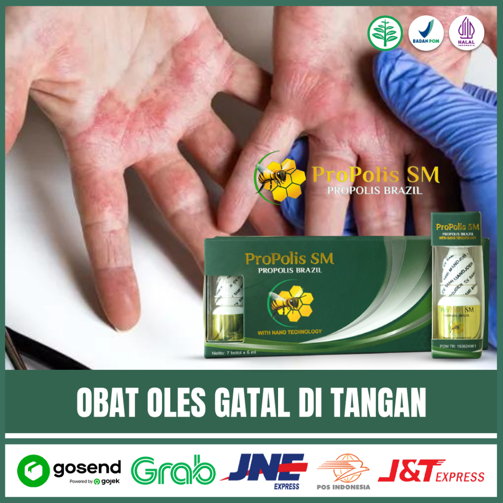 Obat Alergi Gatal Gatal, Jari, Kaki, Tubuh, Kulit Gatal,obat gatal di tanagn Propolis SM Di Surabaya