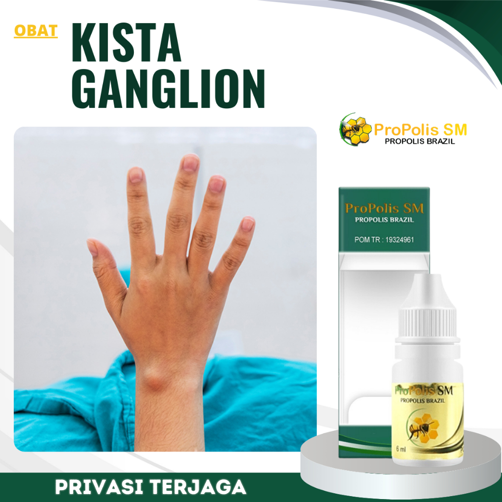 Obat Kista Ganglion, Obat Penghancur Kista Ganglion, Obat Benjolan Di Pergelangan Tangan,   Obat Pen