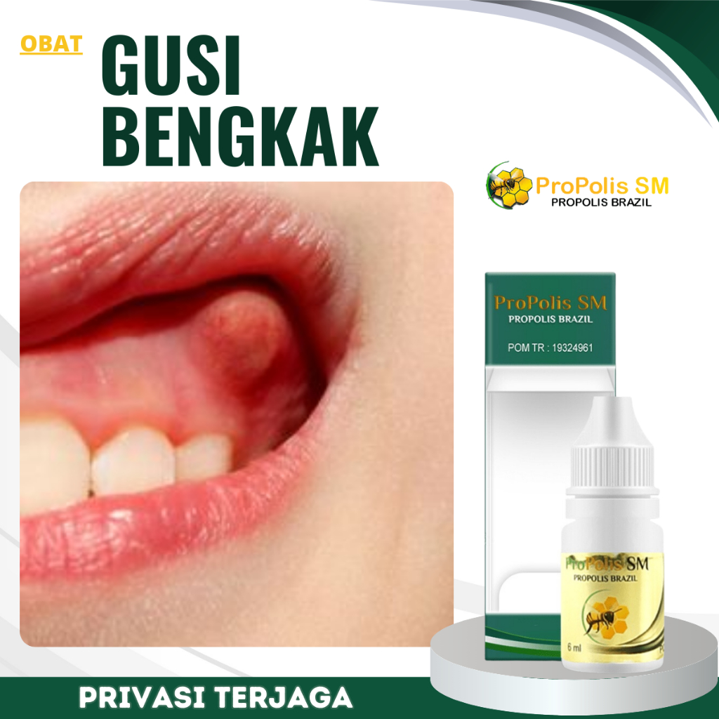 Obat Gusi Bengkak, Obat Sakit Gusi Bengkak, Obat Gusi Bernanah, Obat Gusi Bengkak Akibat Gigi Berlub