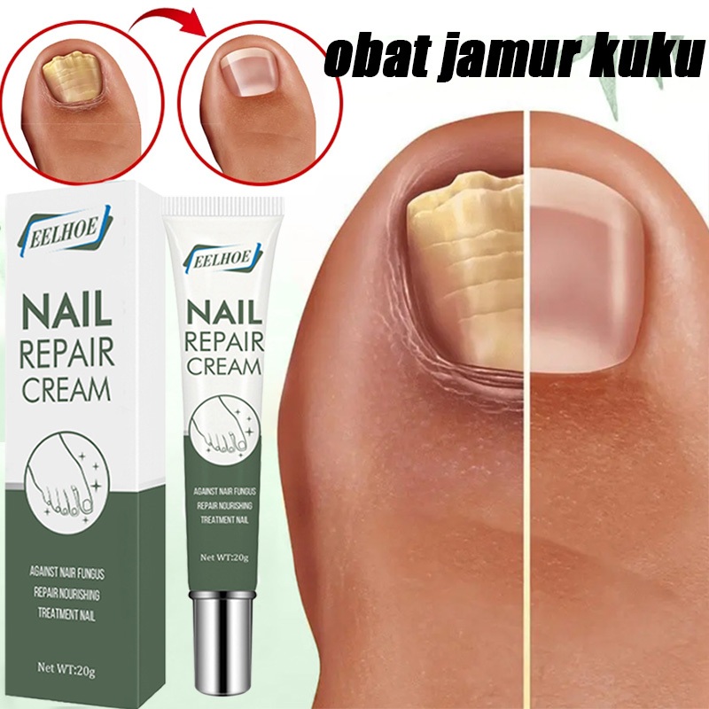 obat jamur kuku salep kuku jamur dan rusak jamur kuku obat paling ampuh 20g perawatan kuku obat kuku