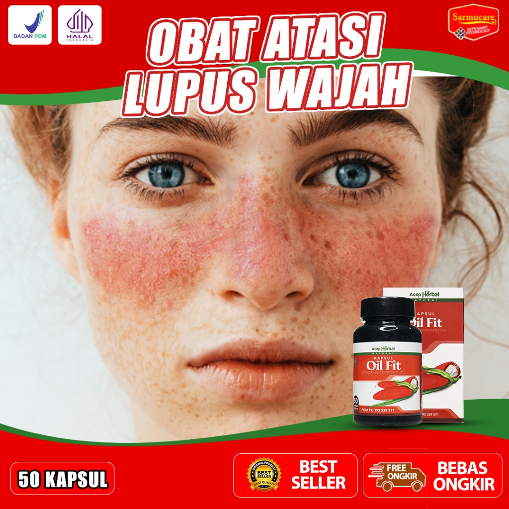 Obat Lupus Ruam Wajah Autoimun Psoriasis Dermatitis Susu Bercak Kulit Ayam Kering Oil Fit Kapsul
