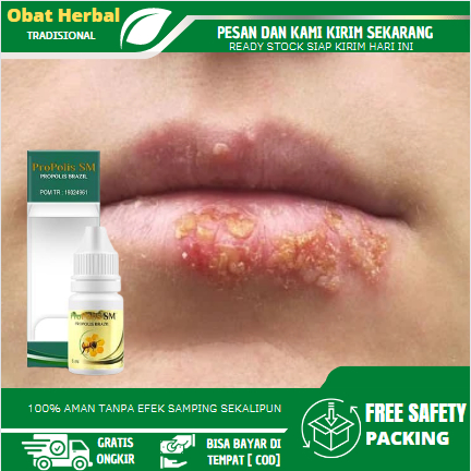 Obat Herpes Bibir, Obat Jamur Di Bibir, Obat Bibir Sakit Dan Gatal, Obat Herpes Di Bibir & Mulut, He