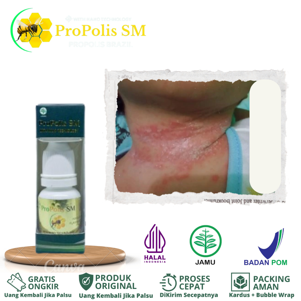 ProPolis SM - Obat Ruam Merah Pada Leher Bayi, Biang Keringat, Iritasi Kulit Bayi, Pitryriasis Alba,