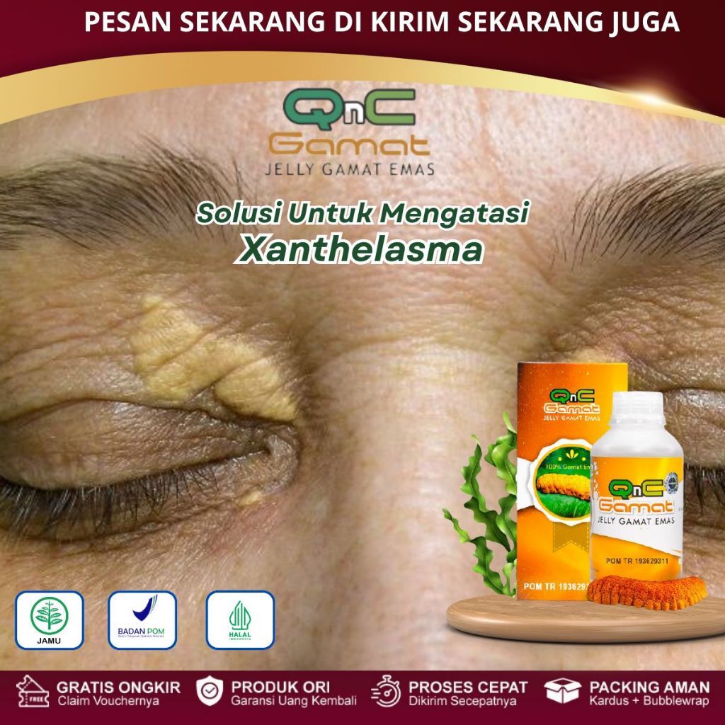 Obat Xanthelasma, Menghilangkan Lemak Di Kelopak Mata, Salep Mata Xanthelasma, Plak Kuning Di Kelopa