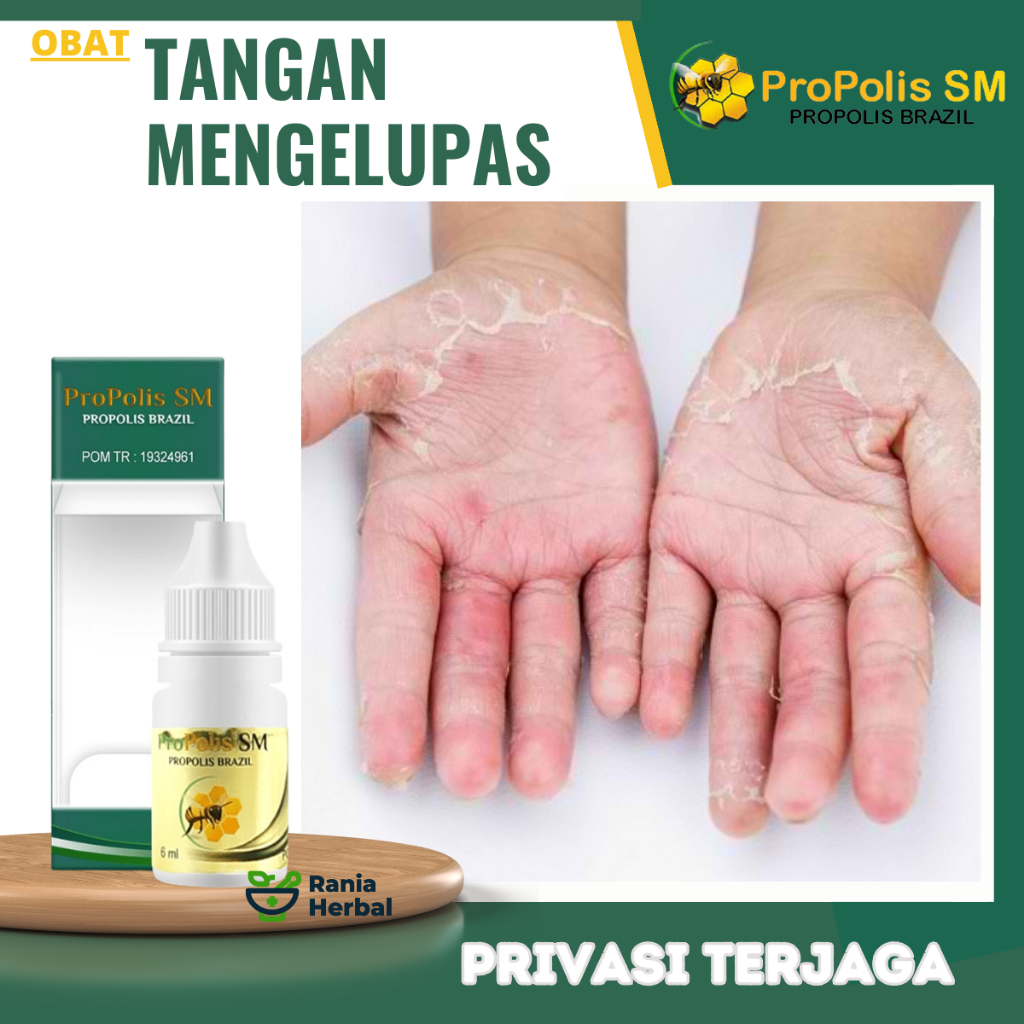 Obat Oles Penghilang Telapak Terkelupas, Cairan Oles Kulit Tangan Kering Bersisik dan Mengelupas, Ob