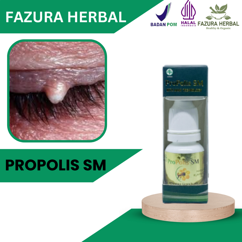 Propolis SM - Obat Benjolan Kecil Di Kelopak Mata, Obat Kutil di Kelopak Mata, Obat Penghilang Milia