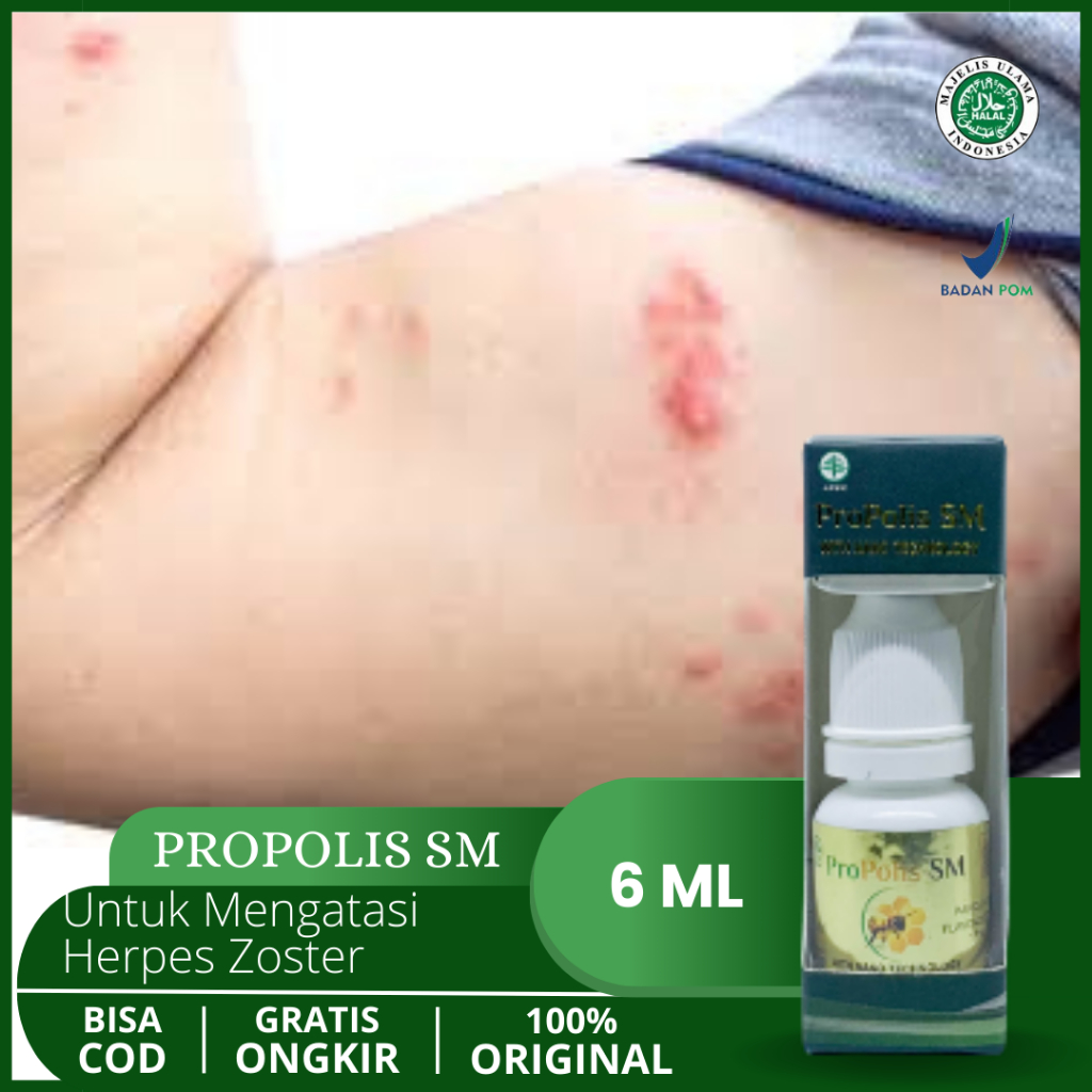 Obat Oles Mengatasi Herpes Zoster, Herpes Kulit, Herpes Bibir, Herpes Genital/Herpes Kelamin, Menghi