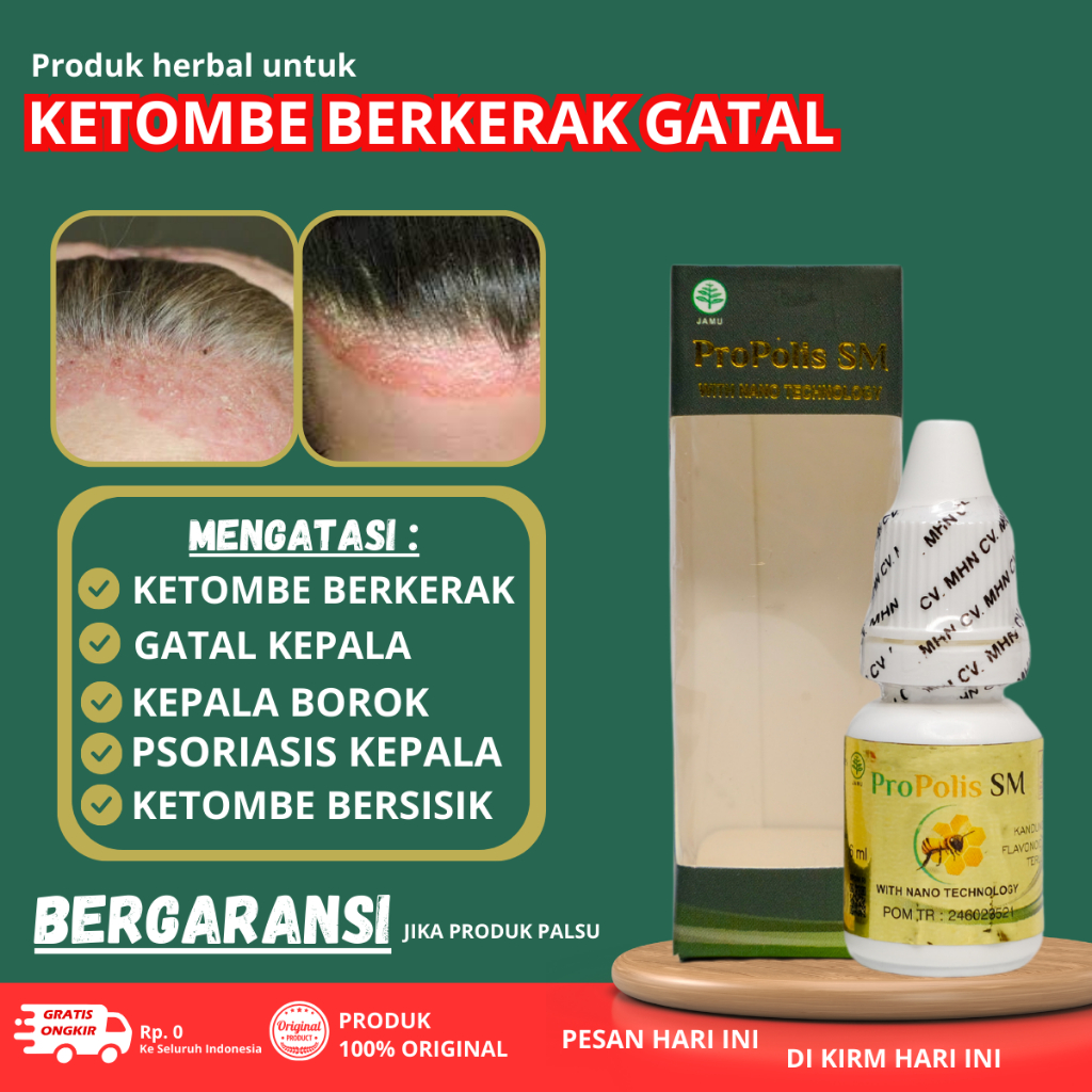 Obat ketombe rambut, Obat Ketombe berkerak, Obat Ketombe berkerak parah, Obat Borok kepala, Obat Ket