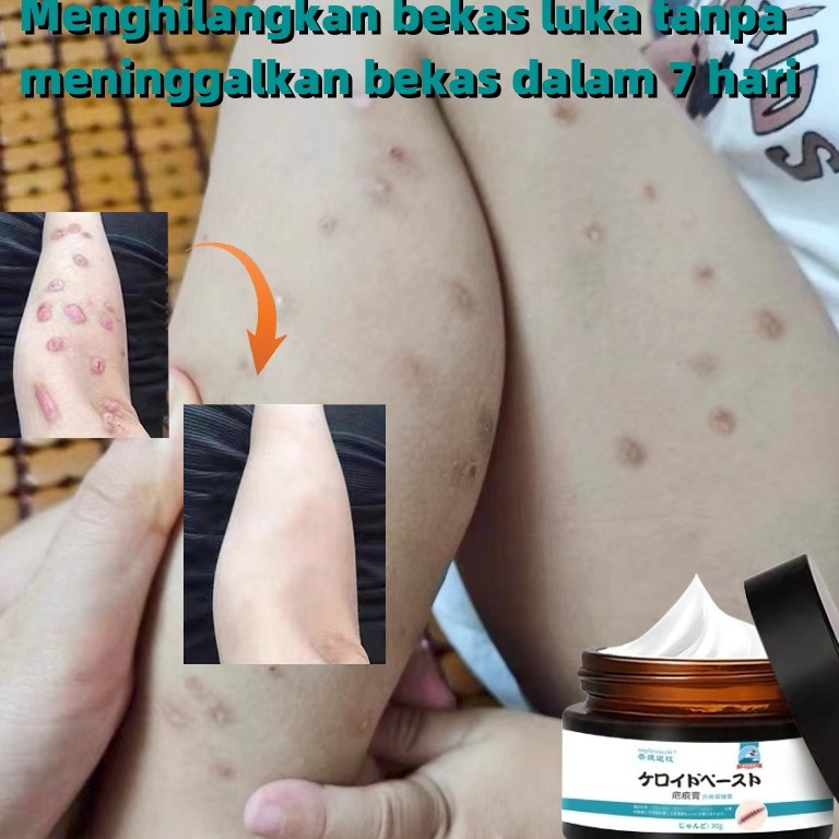 Scar Remover Cream Penghilang Bekas Luka Koreng Scar Remover Cream Obat Penghilang Bekas Luka Lama H