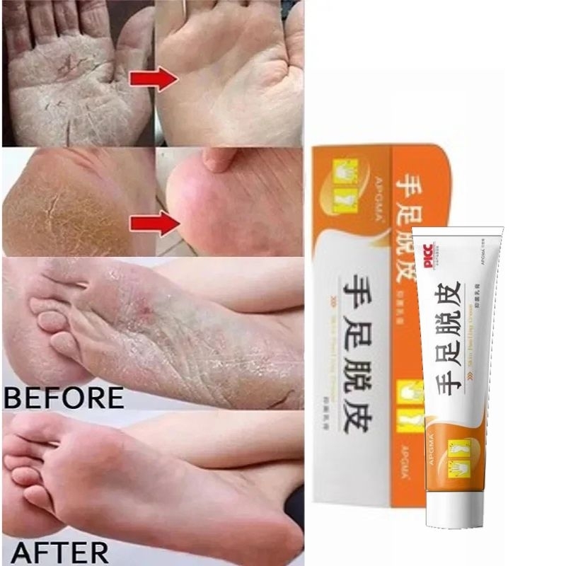 PICC SALEP HERBAL SHOUZU TUOPI SALEP HERBAL ATASI KULIT KERING PECAH PECAH MENGELUPAS TUMITKU KANNA