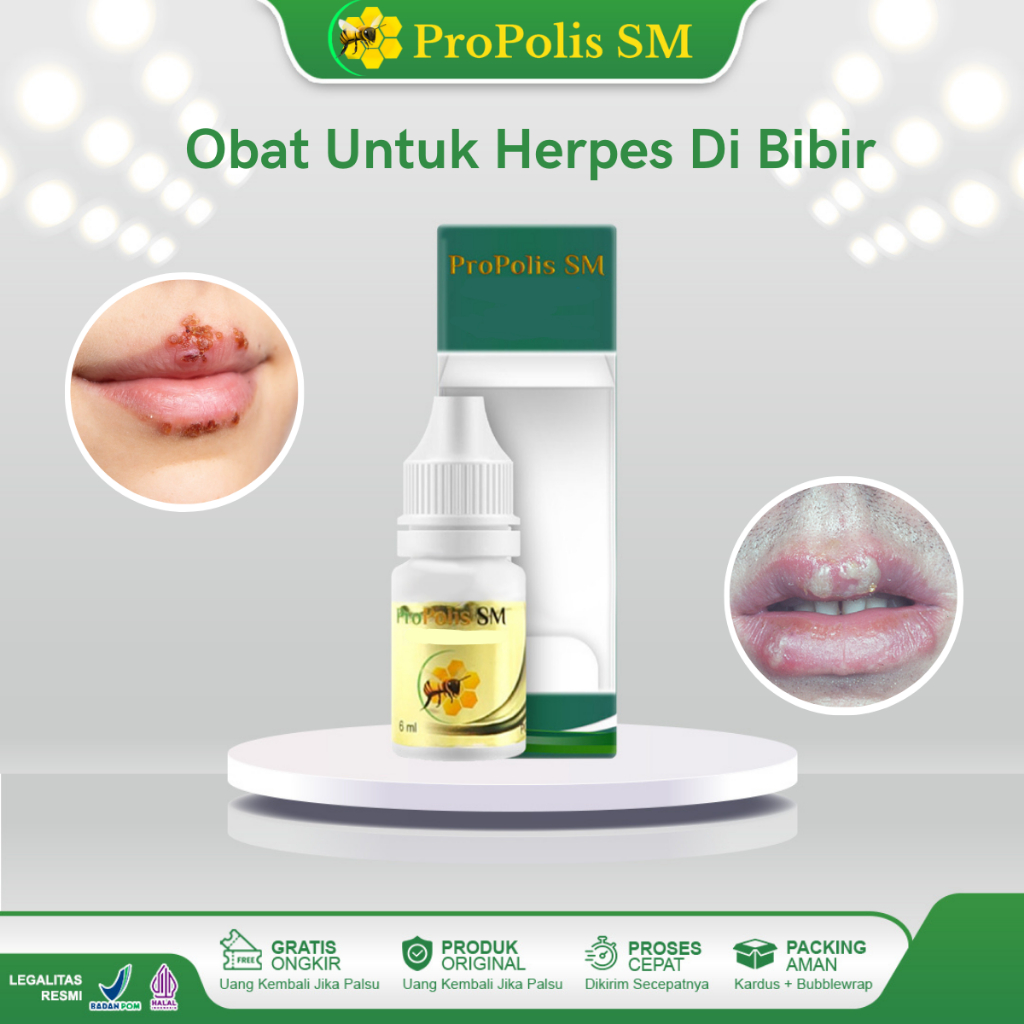 Obat Herpes Di Bibir Bintik Bintik Putih Di Bibir Bintik Putih Berair Di Bibir Mempercepat Sembuhkan