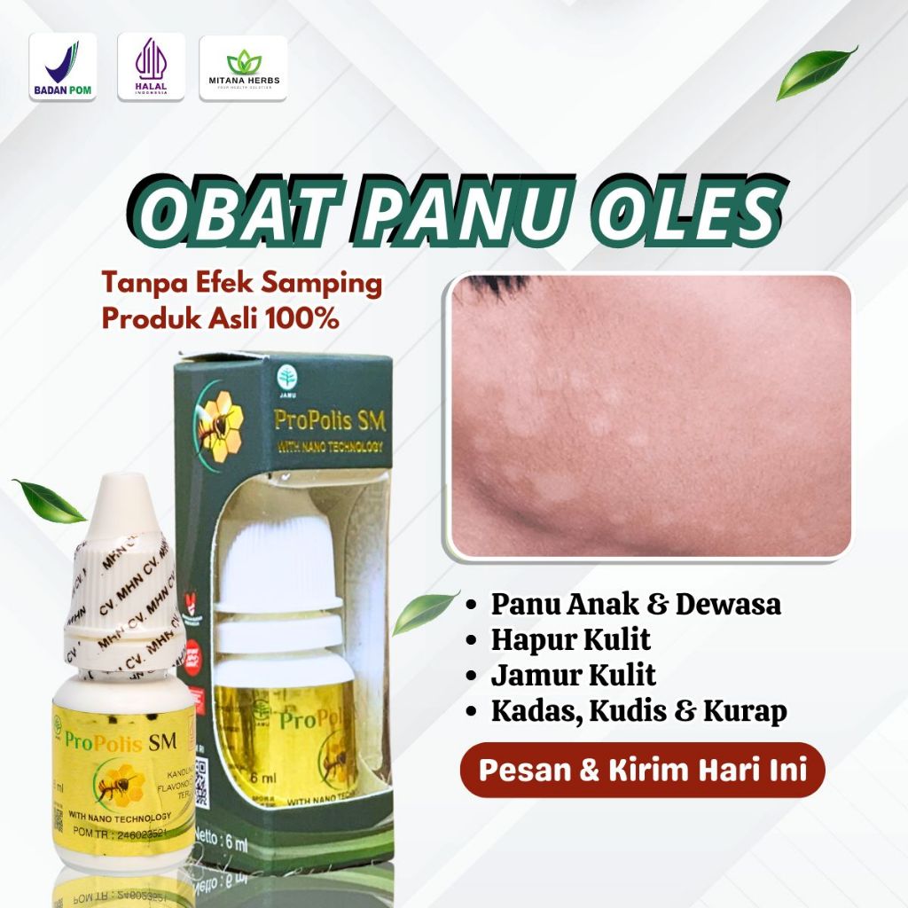 Obat Pengilang Panu, Obat Panu Cair, Obat Jamur Kulit, Obat Panu Di Wajah, Obat Hapur Kulit, Obat Pa