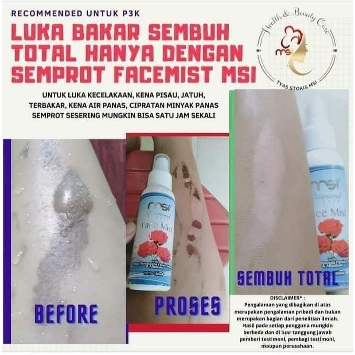 MSI FACE MIST Untuk Perawatan Luka jatuh dan luka bakar