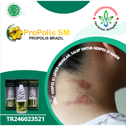 ANUGRAHHERBAL) Obat herpes di leher m3nular, Obat Oles herpes di leher, Ngilangin herpes di wajah, P