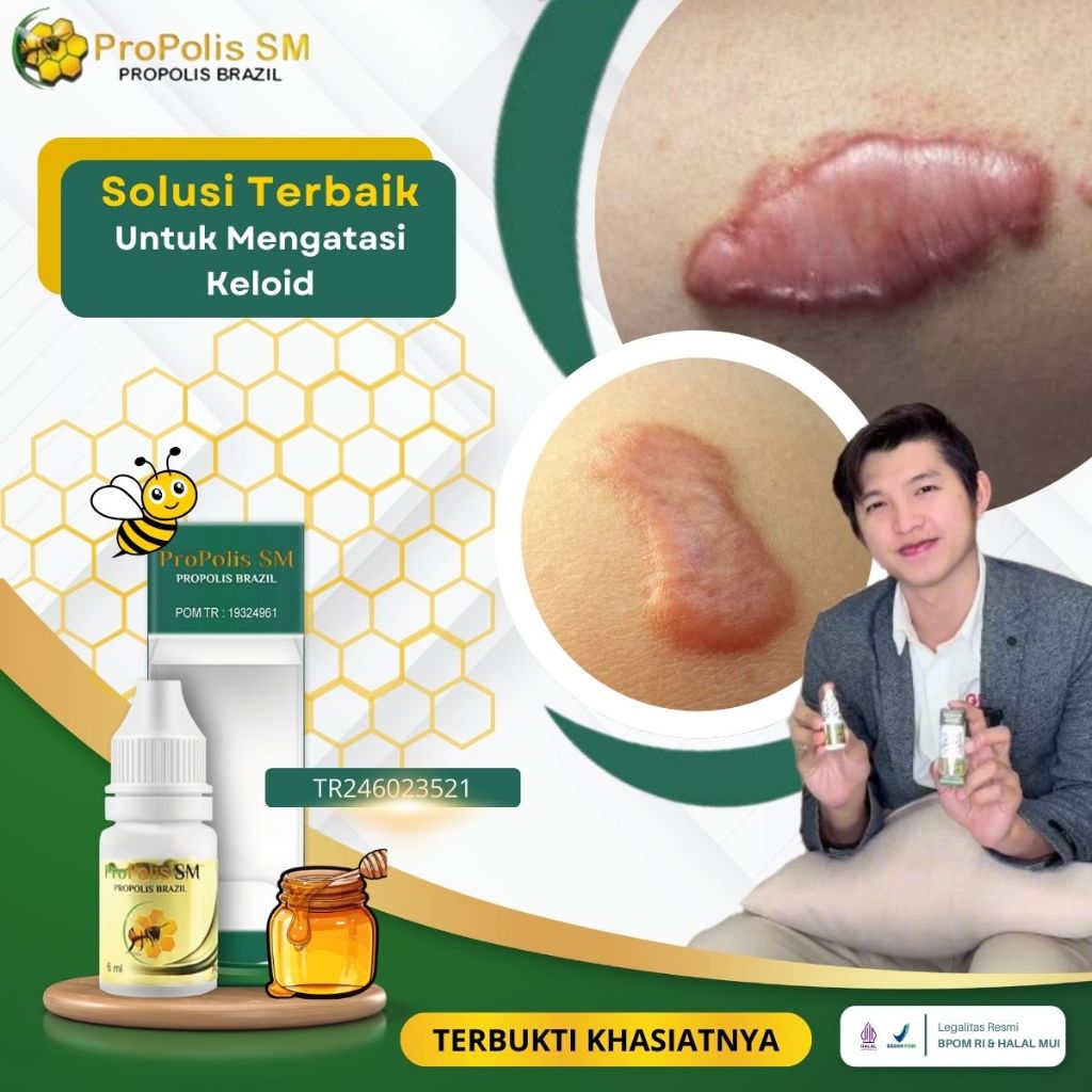 Propolis Asli Original - Obat Keloid Menonjol Tahunan, Obat Keloid Daging Tumbuh, Keloid Bekas Luka