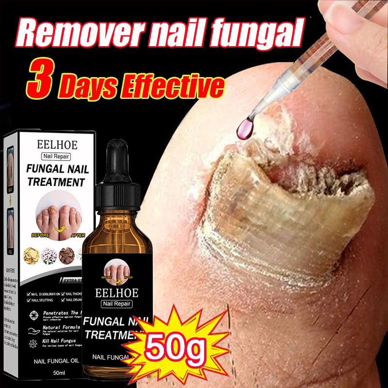 Obat Jamur Kuku Obat kuku jamur dan rusak Perawatan Kuku Berjamur Antibakteri Perawatan Kuku