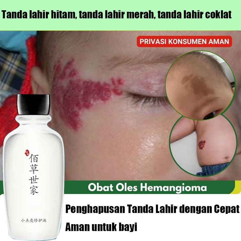 penghilang tanda lahir hemangioma penghilang tanda lahir coklat penghilang tanda lahir di wajah obat