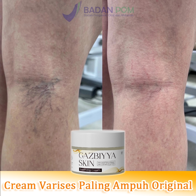 Cream varises paling ampuh original salep varises obat varises salep 30g varises salep laba-laba Vas