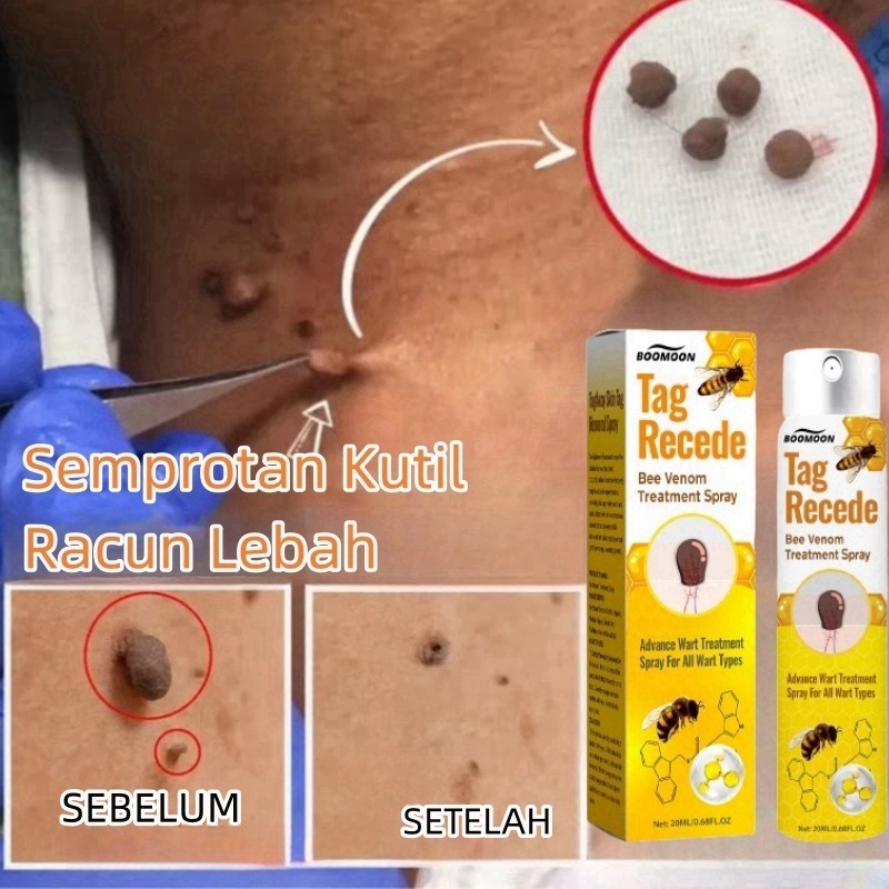 Penghilang kutil wart remover pembersih kutil penghilang kutil dan tahi lalat menghilangkan kutil