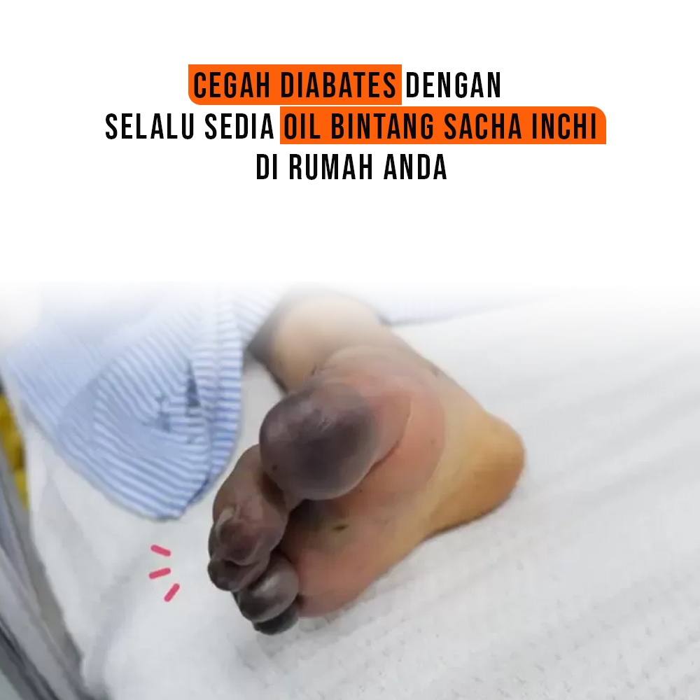 Jual Oil Bintang Sacha Inchi Herbal Untuk Diabet