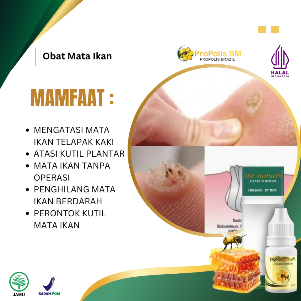 Obat Mata Ikan Telapak Kaki Penghilang Kutil Mata Ikan Kaki Kapalan Kaki Rayapan Telapak Kaki Bolong