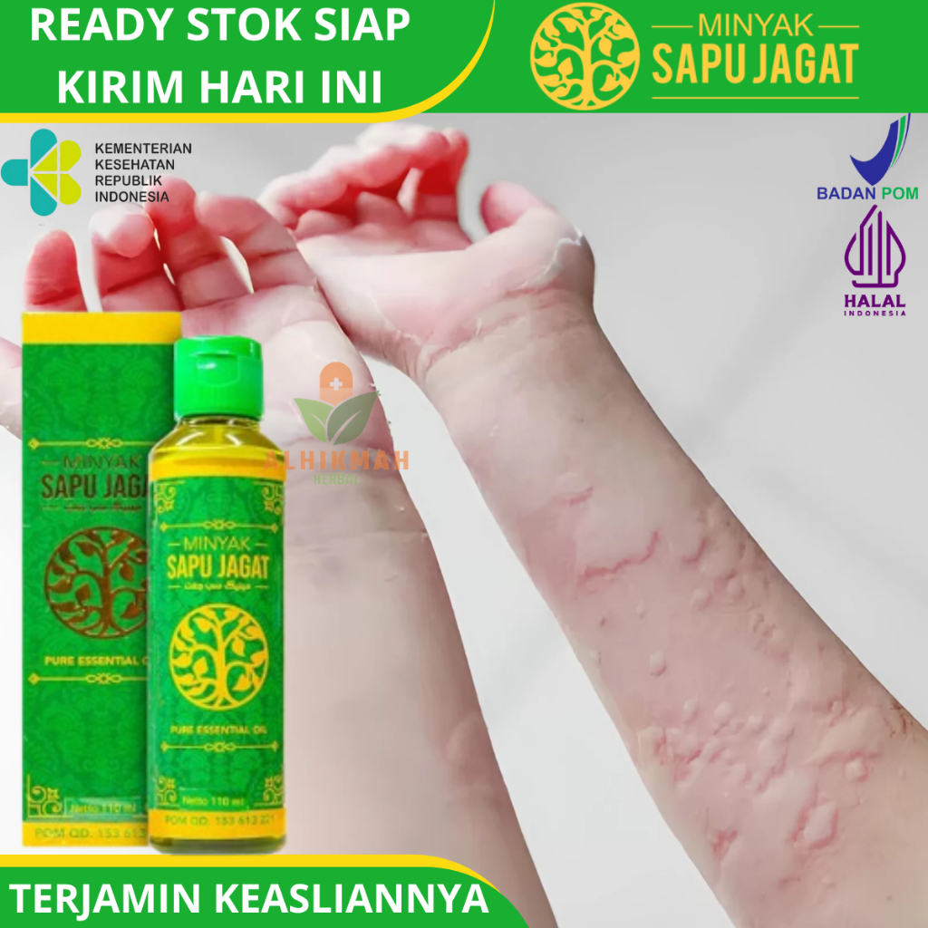 Minyak Oles Kulit Gatal Alergi Biduran Kaligata, Obat Alergi Makanan, Alergi Cuaca, Dan Alergi Debu,