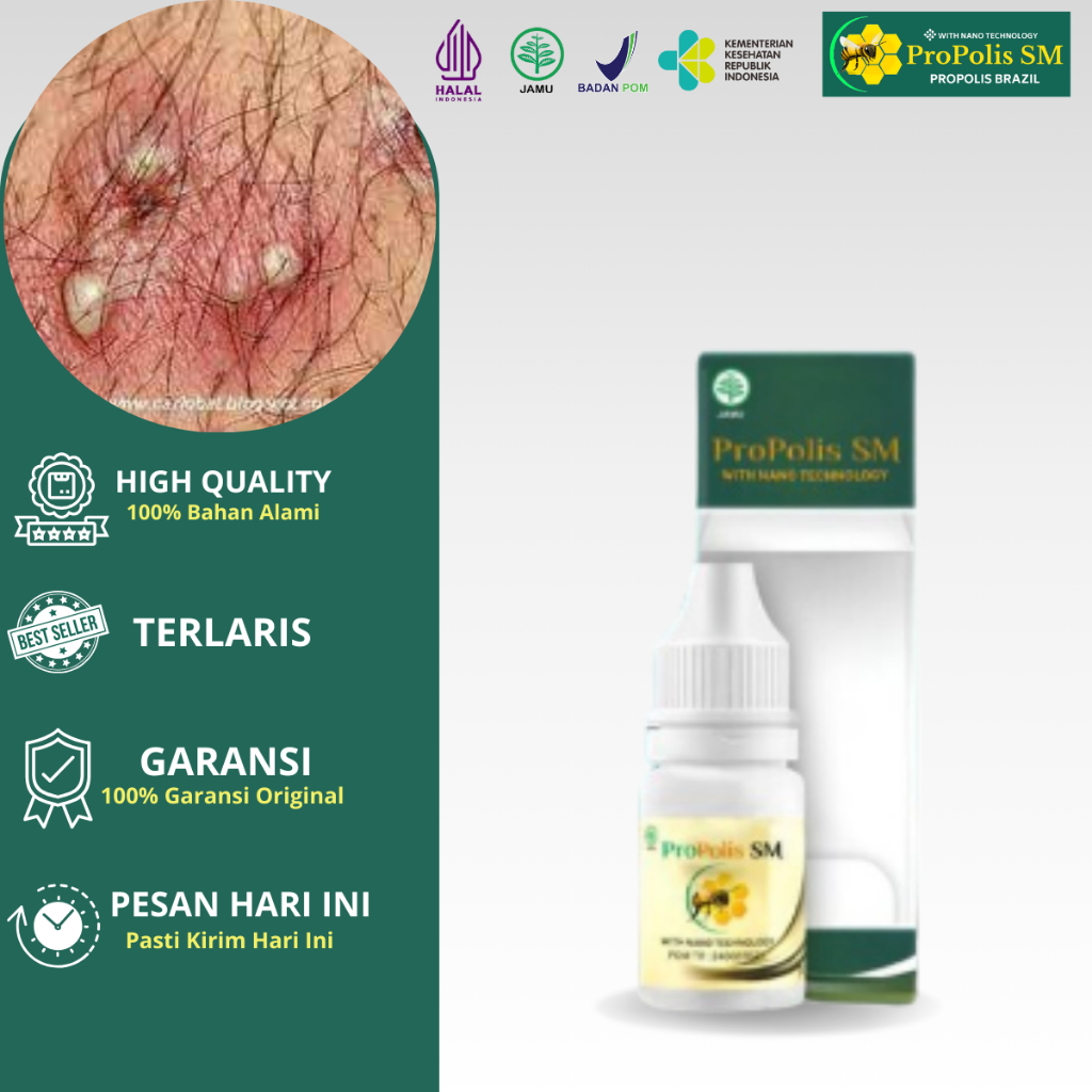 Obat Gatal Buah Zakar Pria, Gatal Kelamin, Gatal Testis, Penyakit Kelamin, Gatal Kulit Buah Zakar,  