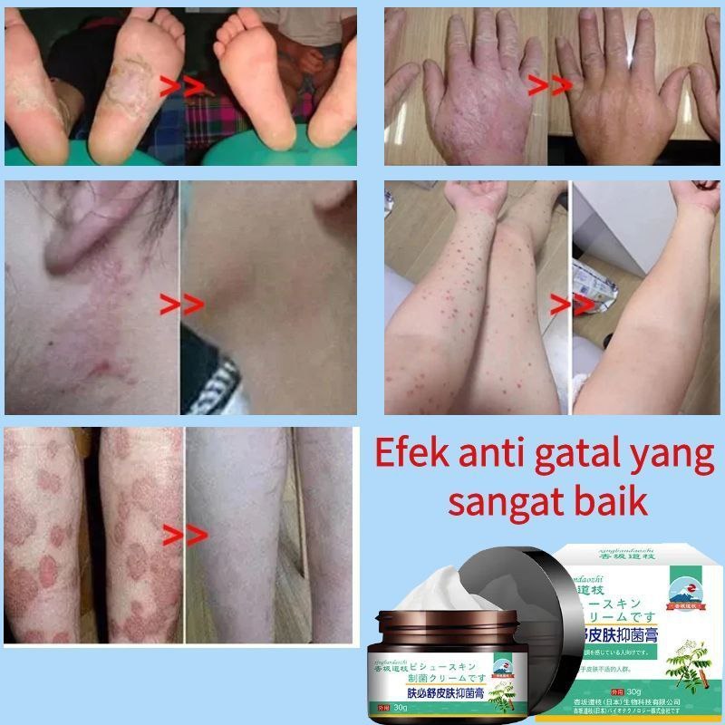 Salep gatal selangkangan salep gatal paling ampuh Obat selangkangan gatal dan hitam krim gatal psori