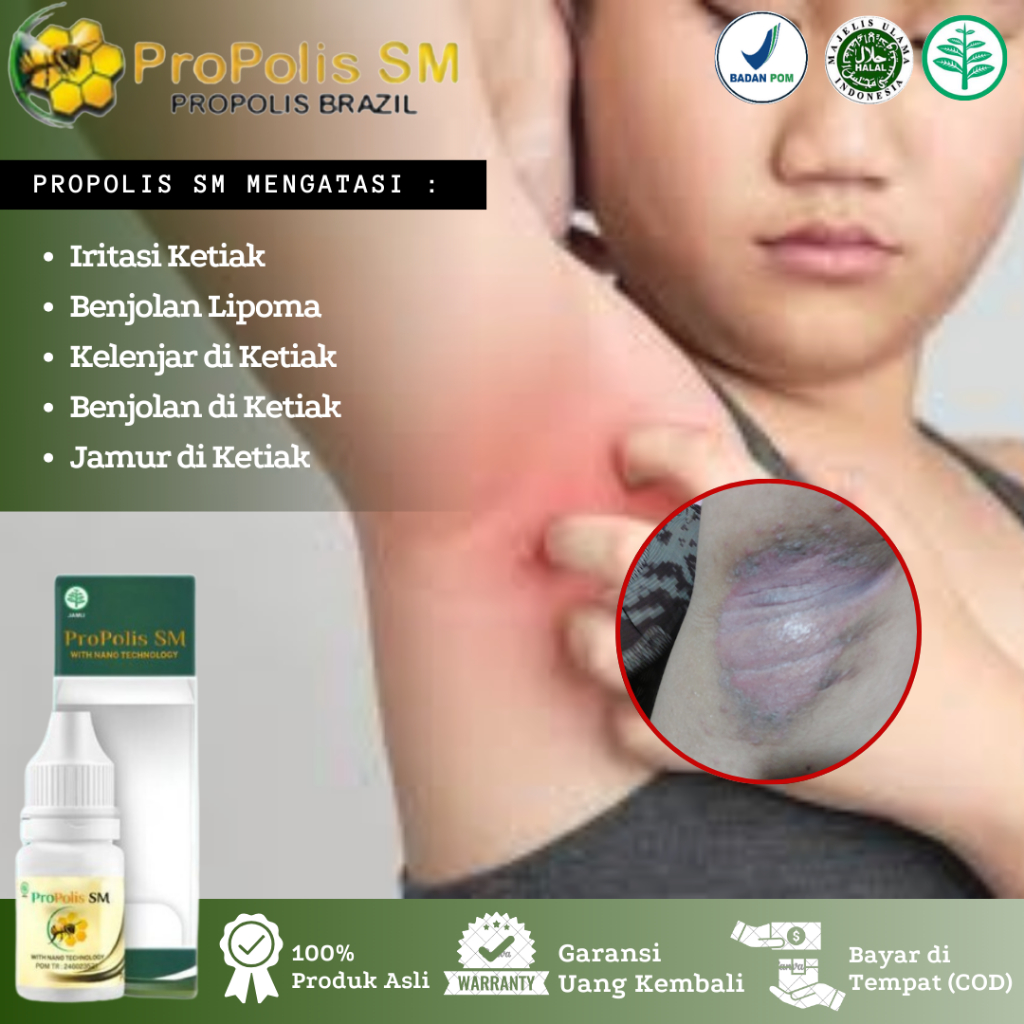 Obat Gatal Ketiak, Iritasi Ketiak, Benjolan di Ketiak, Jamur di Ketiak, Eksim Ketiak, Ketiak Hitam, 