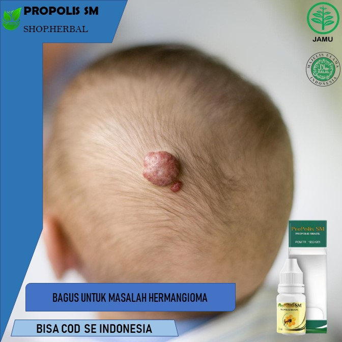 obat hemangioma Obat Herbal Hemangioma PROPOLIS SM | Pengobatan Herbal Hemangioma Bayi, Obat Herbal 