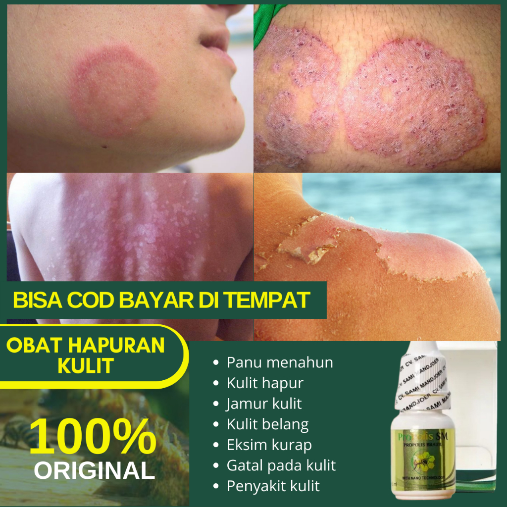 Obat Hapuran Kulit, Obat Panu di Wajah Untuk Anak, Obat Penghilang Balas Bogo Membandel, Obat Herbal